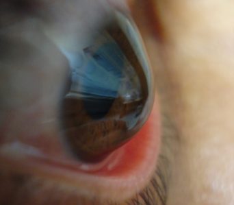 Queratocone – Degeneração Marginal Pelúcida – Astigmatismos