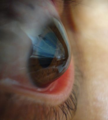 Queratocone – Degeneração Marginal Pelúcida – Astigmatismos